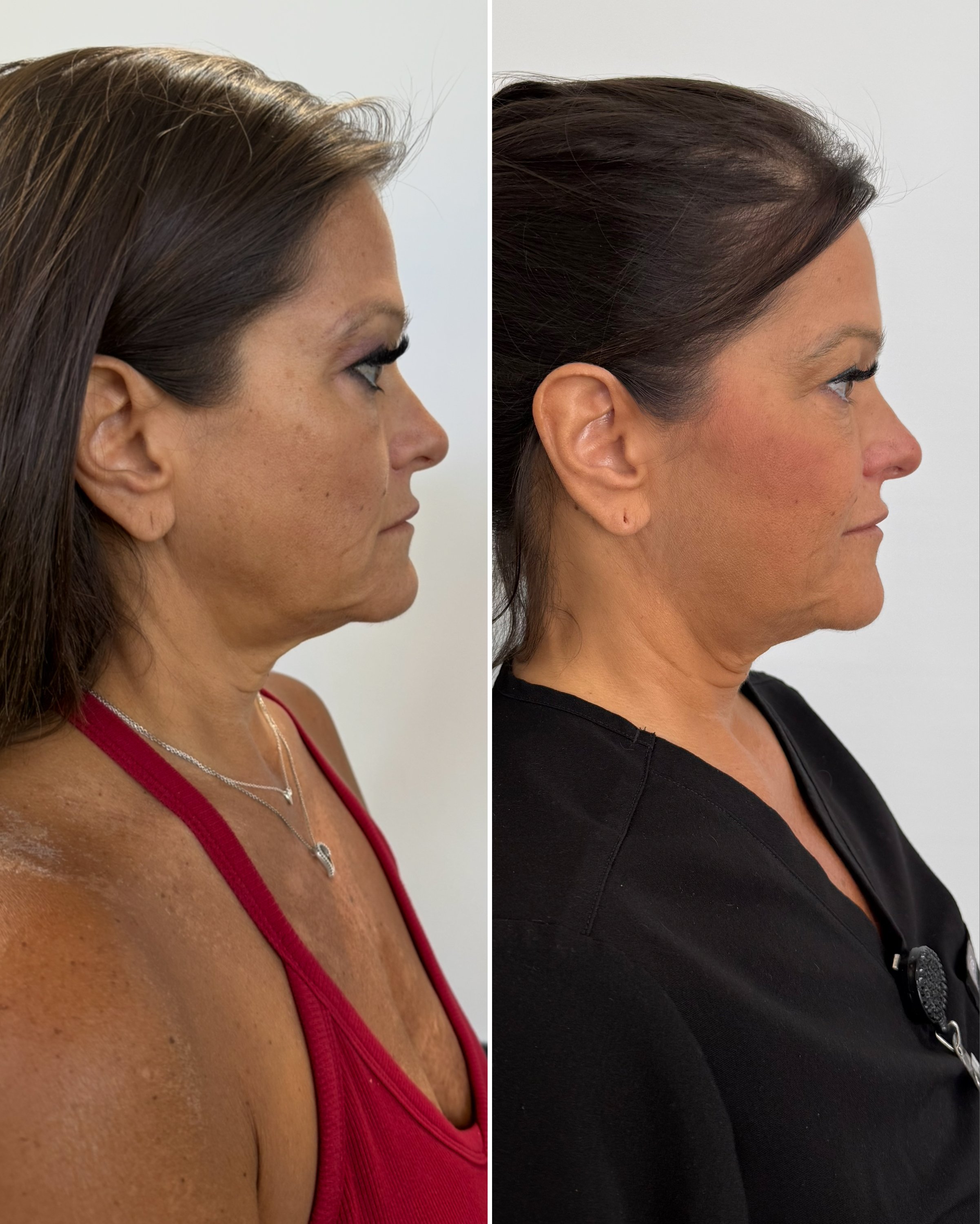 Side-by-side comparison of a woman before and after a cosmetic procedure, showing improvements in skin texture and appearance.