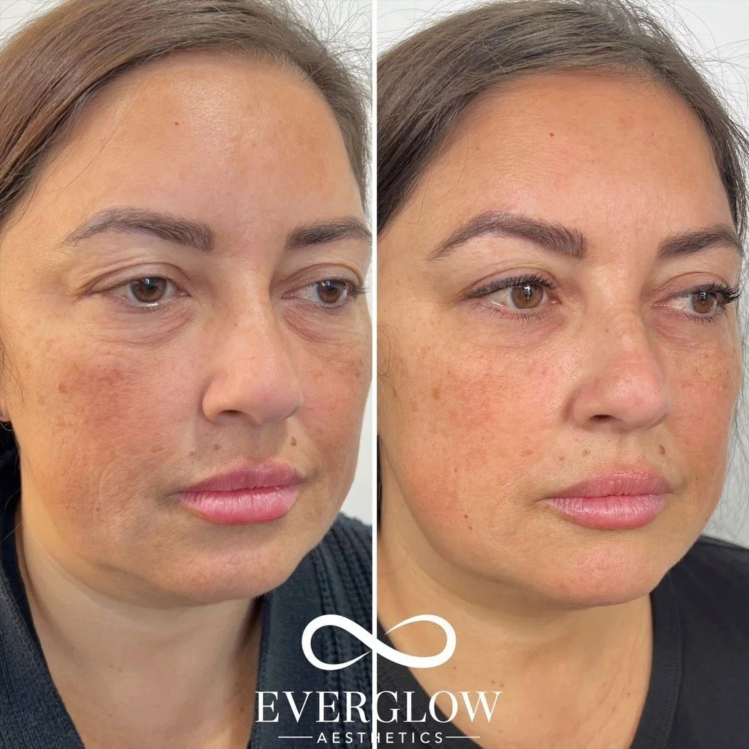 Before and after comparison of a woman's face showing improvements in skin texture and tone, likely after a skincare treatment or cosmetic procedure, with the logo of EverGlow Aesthetics.