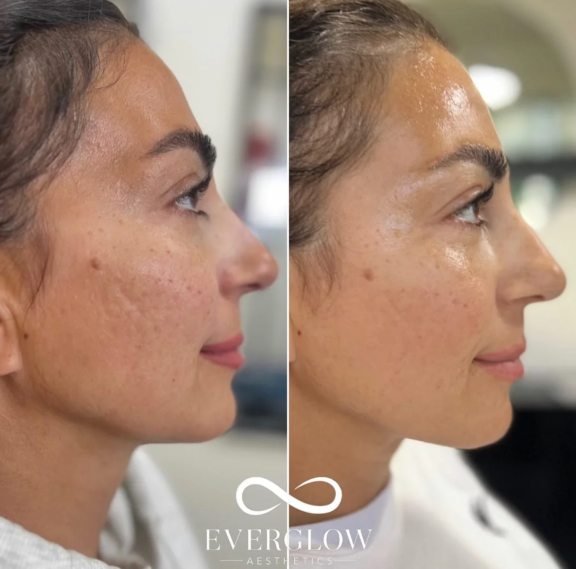 Comparison of a woman's face before and after skincare treatment, showing improved skin texture and clarity.