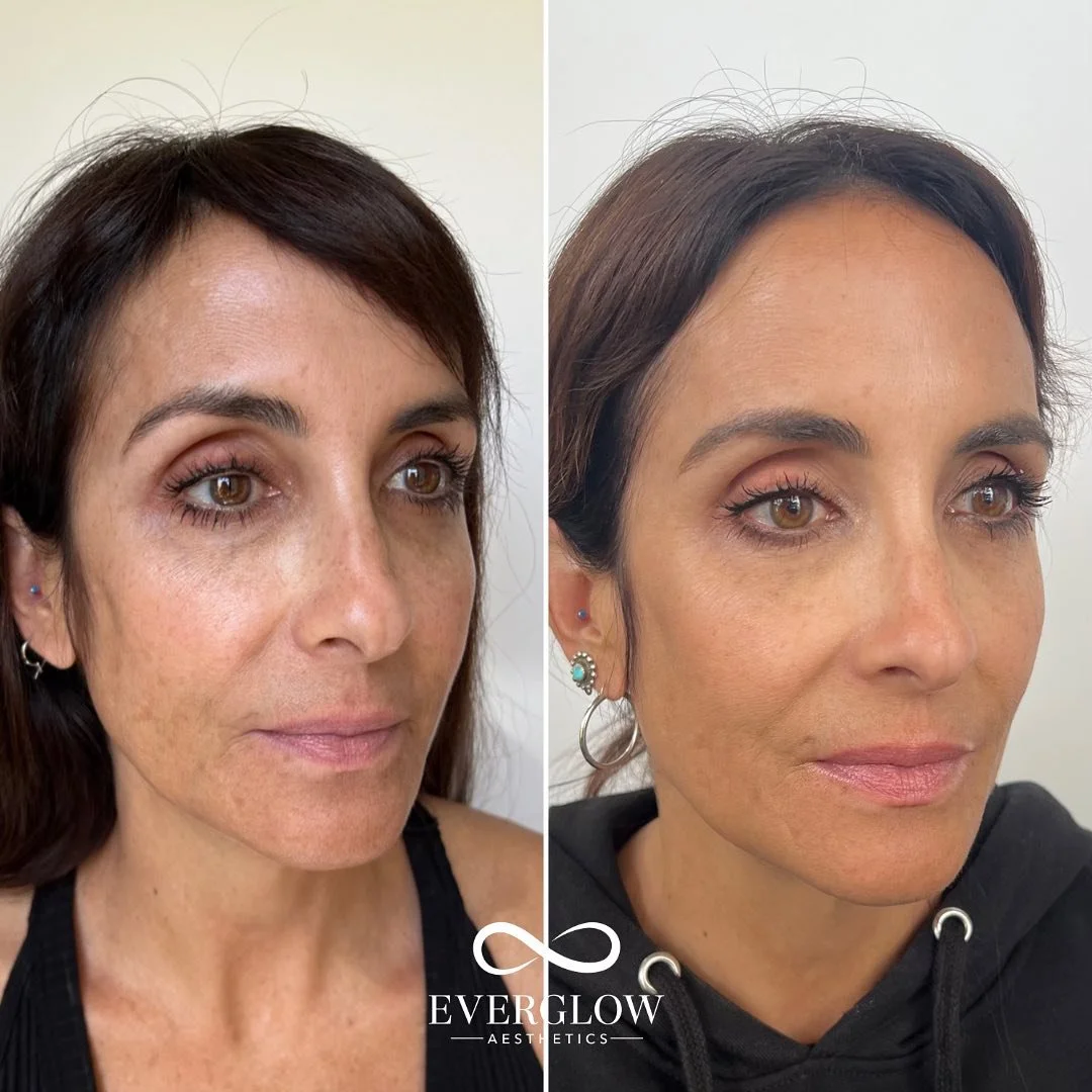 Side-by-side comparison of a woman before and after skincare treatment, showing improved skin texture and reduced pigmentation, with the logo 'Ever Glow Aesthetics' at the bottom.