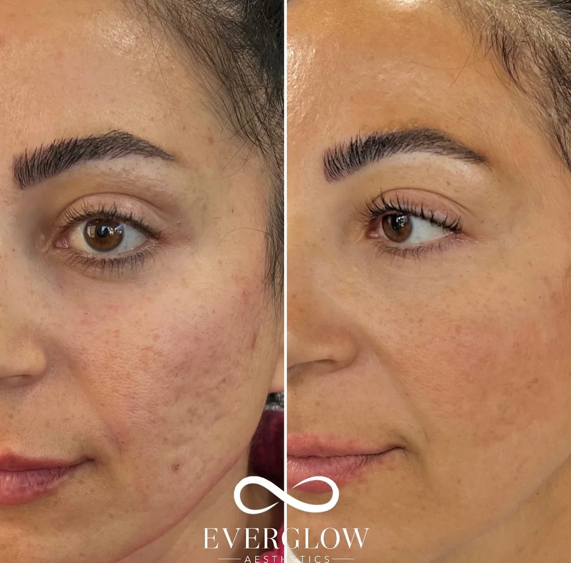 Side-by-side comparison of a woman's face showing improved skin texture and reduced acne scars after skincare treatment. The left image shows skin with acne scars and uneven texture, while the right image shows smoother, clearer skin. The logo of Everglow Aesthetics is at the bottom.
