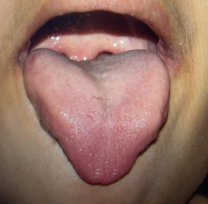 1. before airway.png