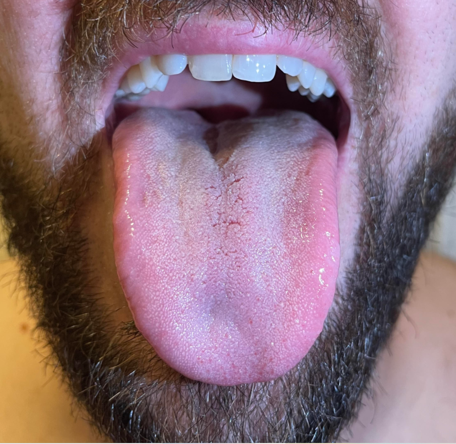 2. before airway .png