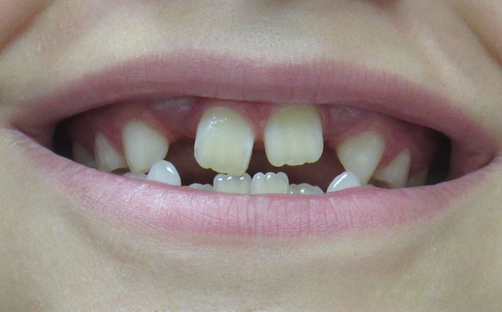 5. after tongue thrust incorrect swallow.png