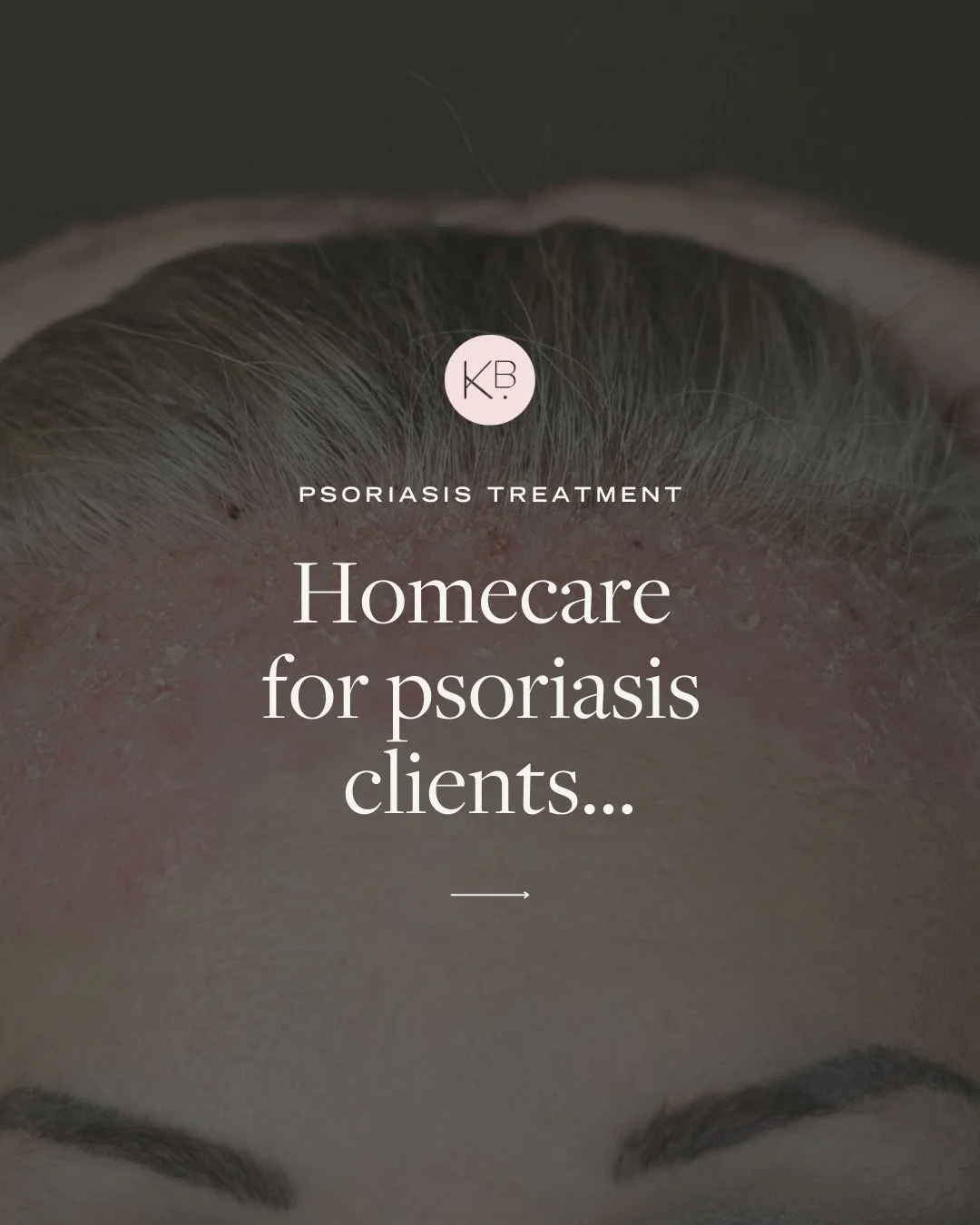 Here is my recommended "Back-to-Basics" routine for psoriasis-prone skin:⁠
⁠
1️⃣ The Gentle Cleanse: Use a non-foaming, soap-free cleanser. Avoid anything that leaves your skin feeling "tight," as this strips your natural acid man