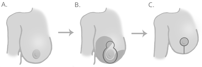 vertical mammoplasty