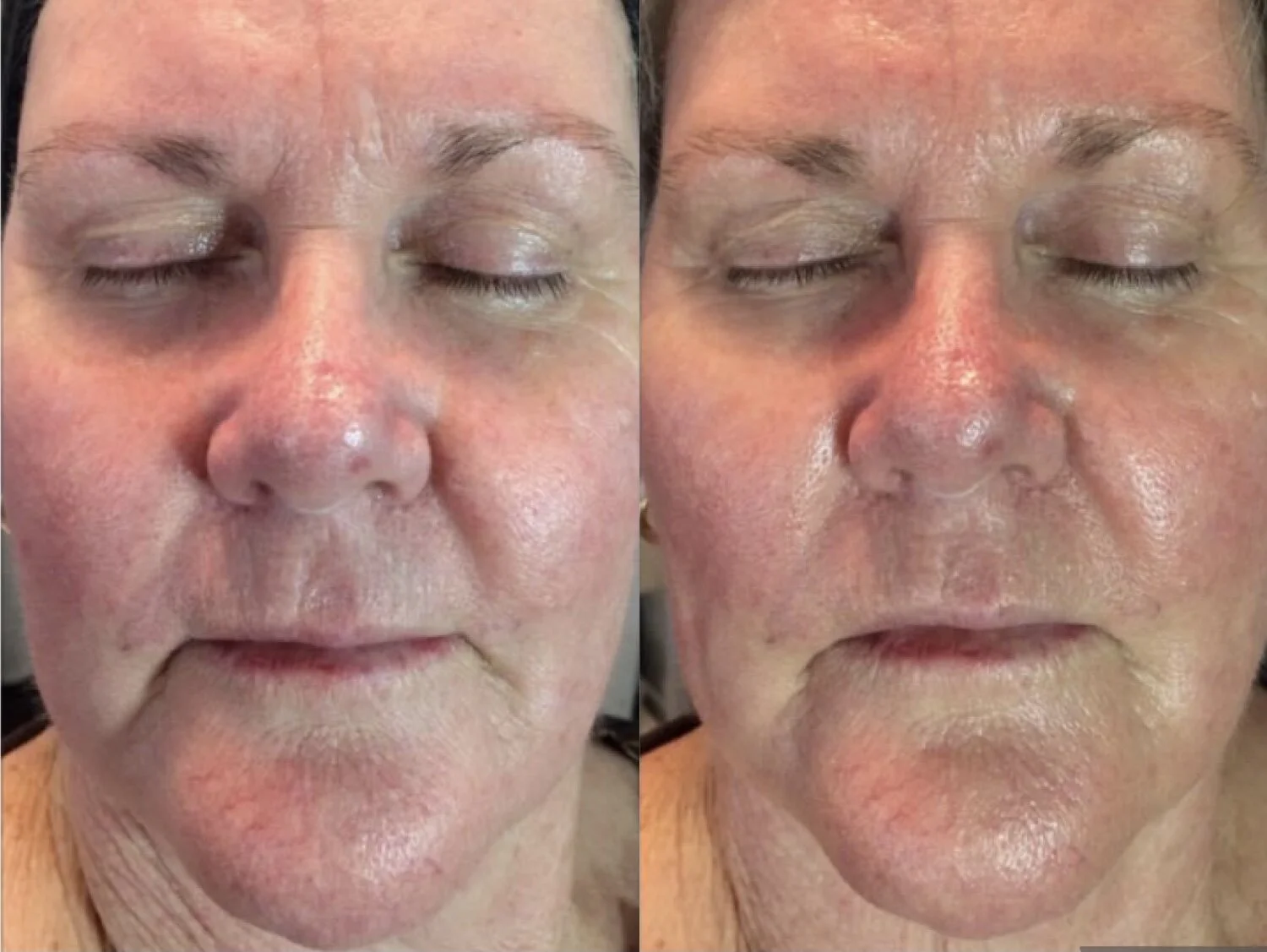 Microcurrent Sculpting — KITTY KAT SKIN & BEAUTY