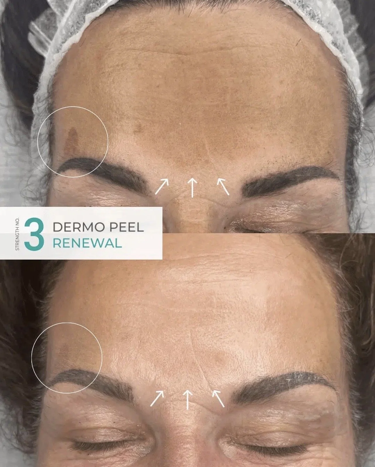 Before and after comparison of a person's forehead showing results of a Anesi dermo peel level 3 renewal treatment, with marked improvement in skin texture and appearance.