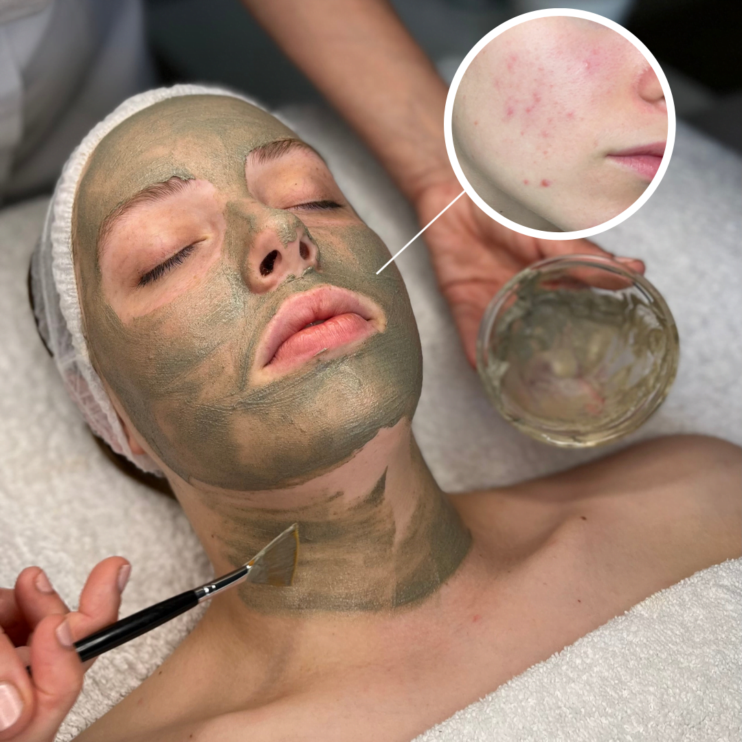 A woman with a Anesi Dermo Spicule Peel lying with eyes closed in a spa or skincare treatment, with a magnified inset showing skin with red pimples or irritation, and a woman applying the mask with a spatula.