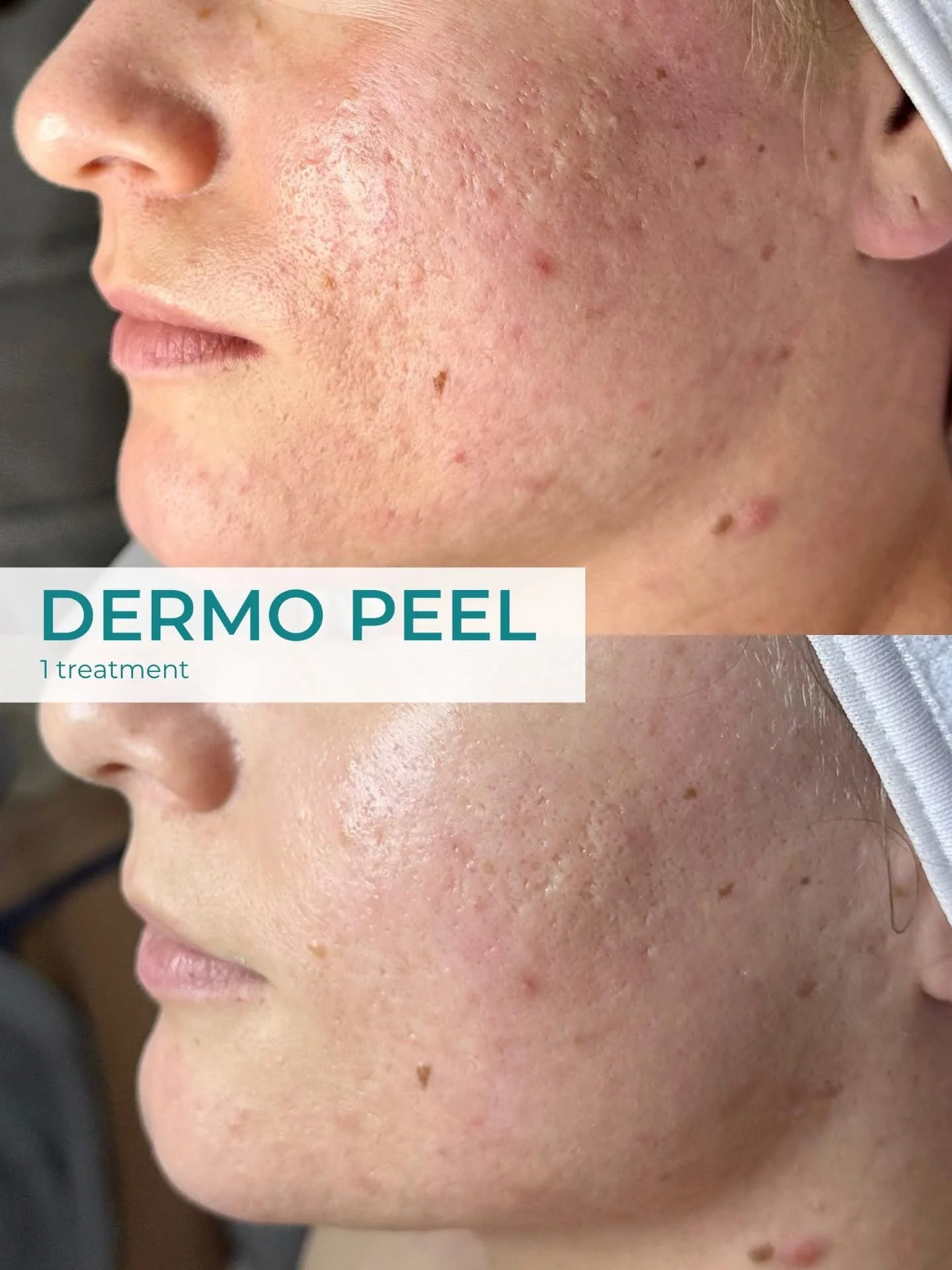 Close-up of a person's cheek showing skin after a Anesi dermo peel level 2 treatment, with visible redness and some blemishes.