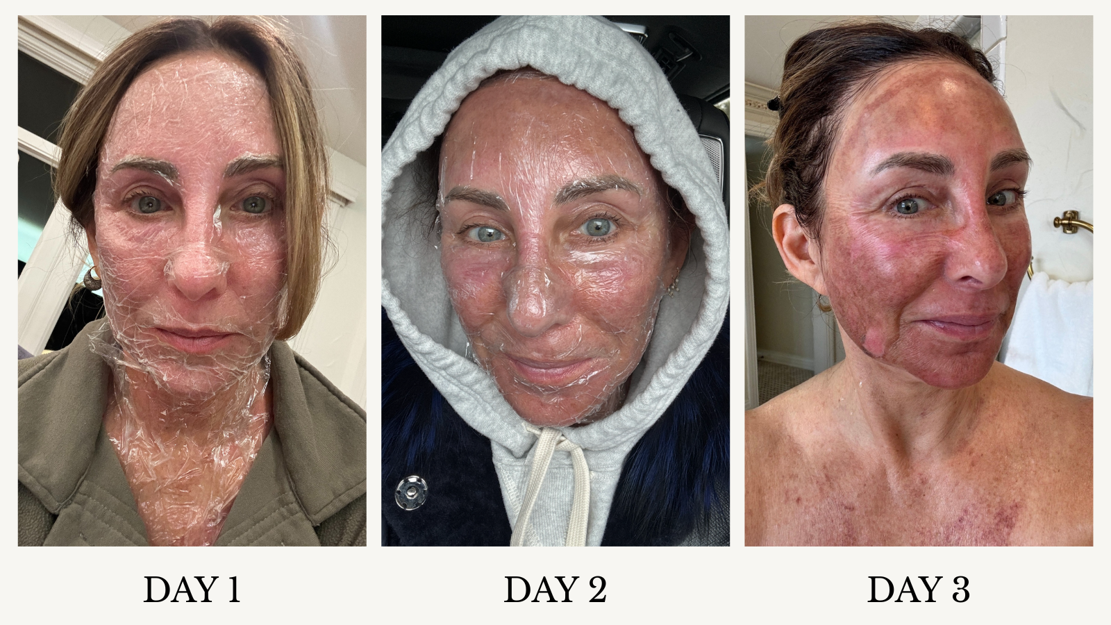 chemical peel recovery