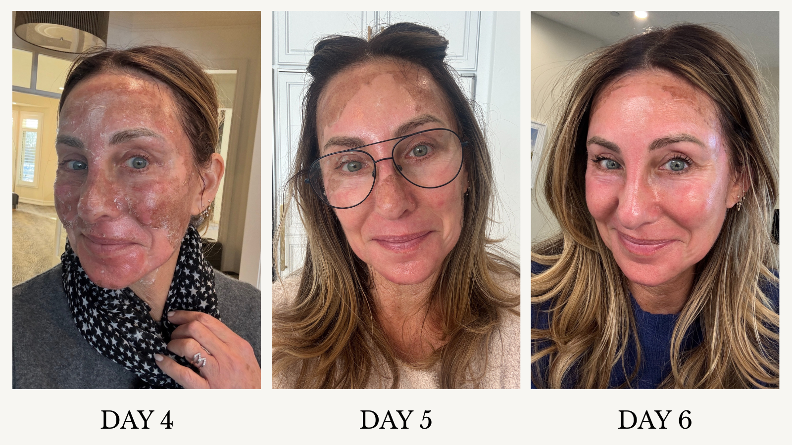 chemical peel recovery