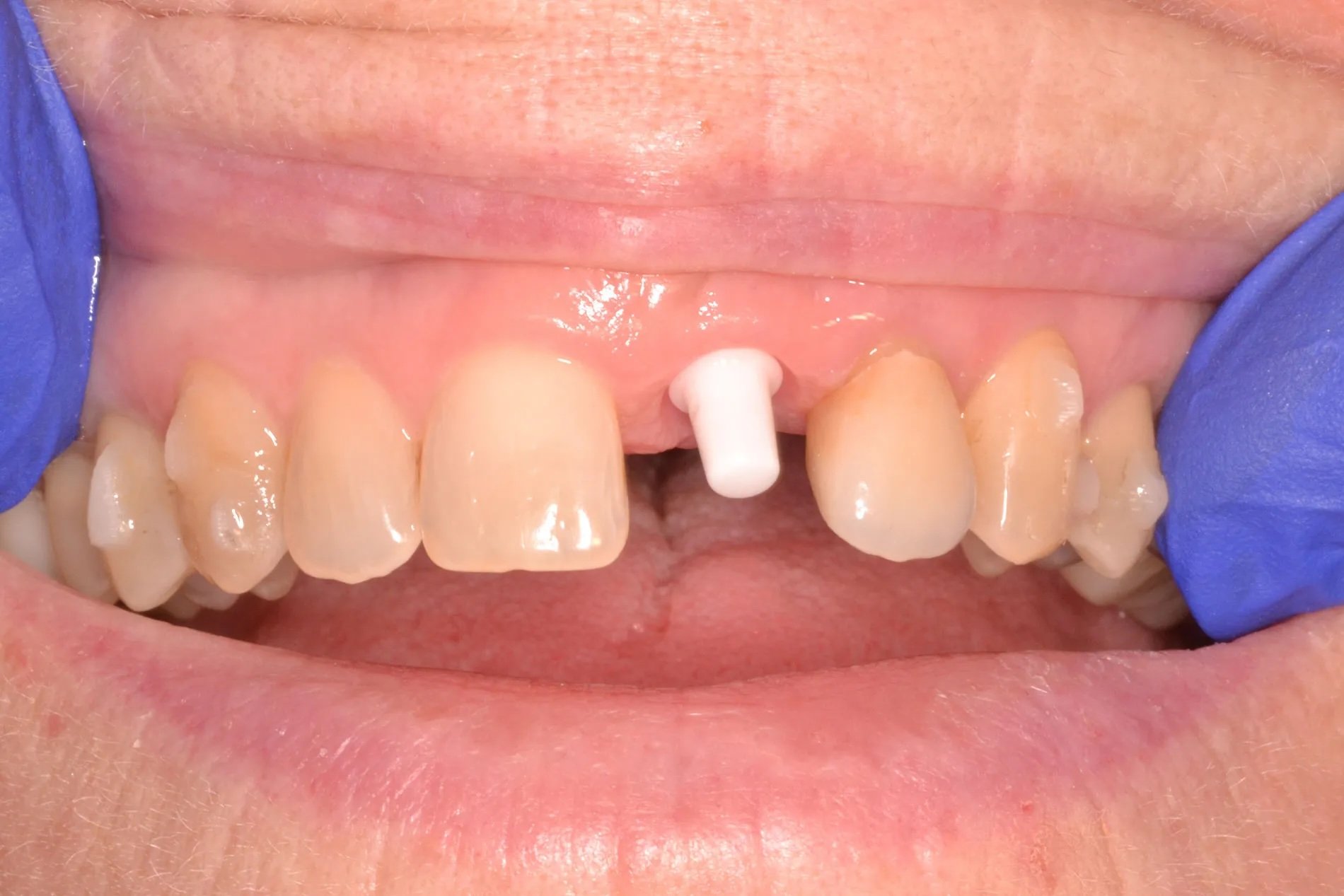 Healing stage: ceramic implant visible between the front teeth