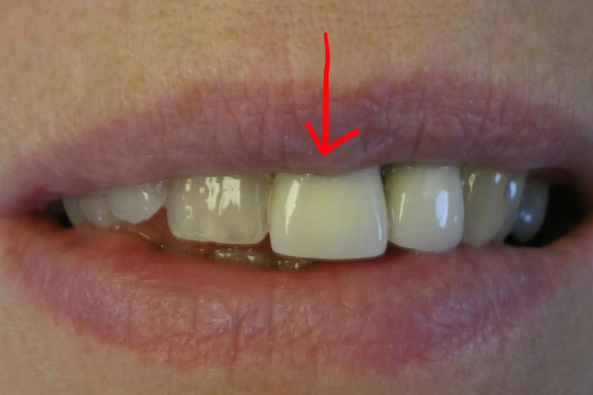Before treatment: front view with an arrow identifying the existing crown