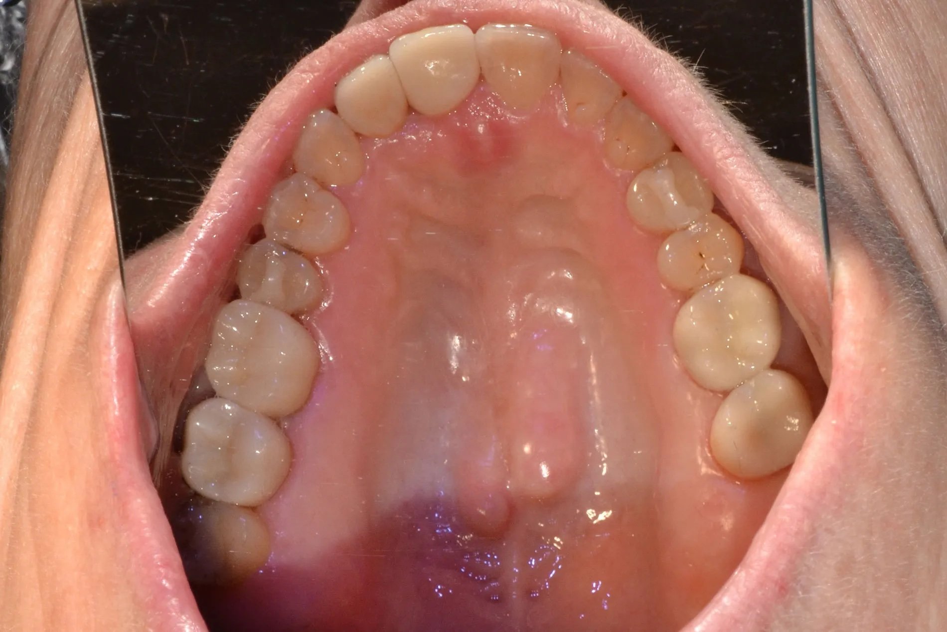 After treatment: view of the upper teeth with completed ceramic restorations