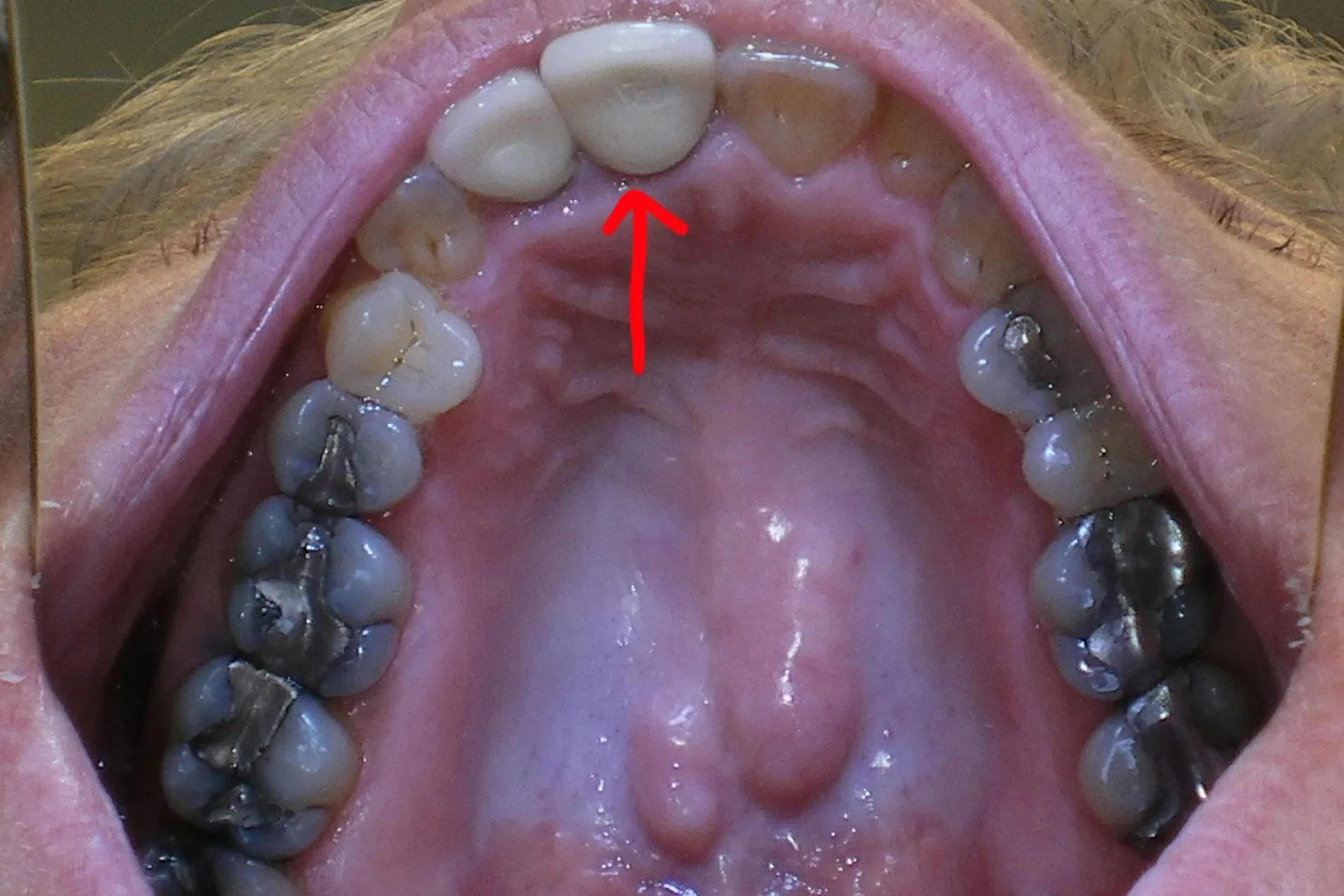 Before treatment: view of the upper teeth with a red arrow marking the affected tooth