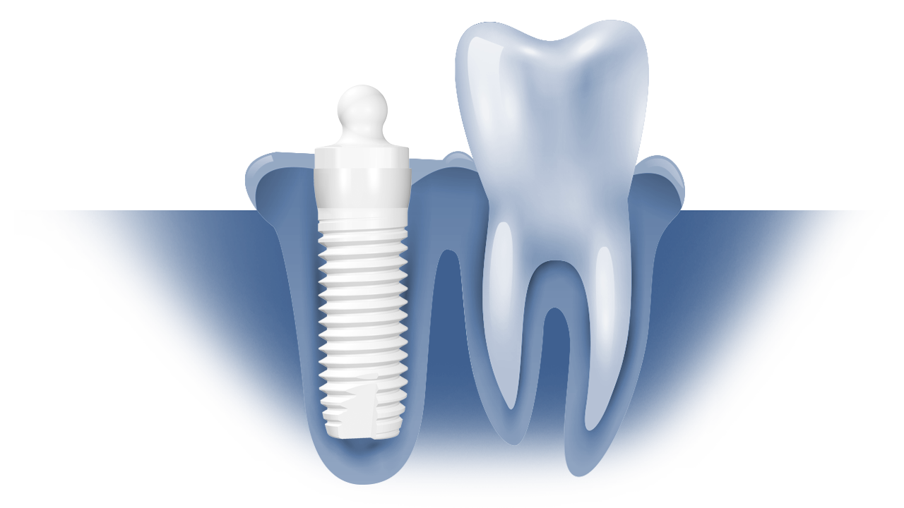 Illustration of a ceramic dental implant and crown beside a natural tooth
