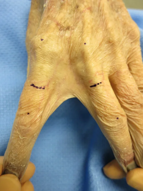 Hand Web Space Tethers — The Cinderella Layer and Fascia Tethers