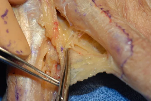 Hand Web Space Tethers — The Cinderella Layer and Fascia Tethers