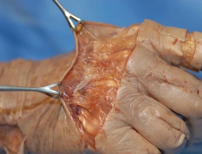 Hand Web Space Tethers — The Cinderella Layer and Fascia Tethers
