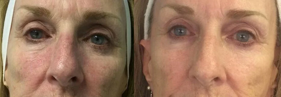 This was with Celluma only. We see a great improvement in facial color and tone. Combining this with facial acupuncture would've relaxed the forehead, softened nasolabial lines, and crows feet further.