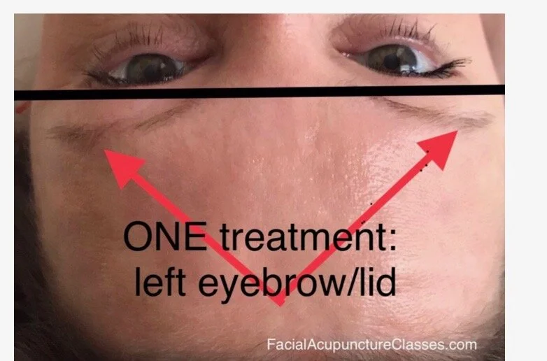Eyebrow lift