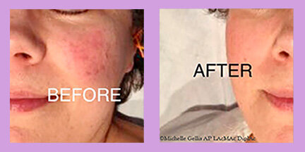 RosaceaGreat success with rosacea treatment! Rosacea can cause unnecessary embarrassment for people. Often mistaken for simple acne or even that the person is red in the face due to shyness, it can create an everyday problem that erodes self-confidence. Treat your rosacea from the inside out and feel more comfortable in your own skin!