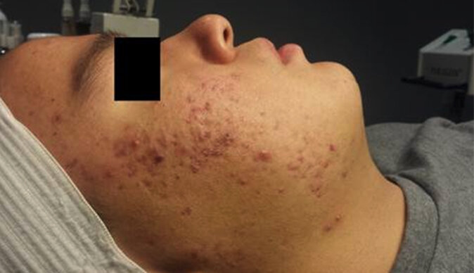 After only 8 Celluma treatments the patient's inflammation has dramatically increased.  Almost no pustules. Adding acupuncture treatment plus herbal medicine would be an amazing complement to these results as well as helping the patient with any cons