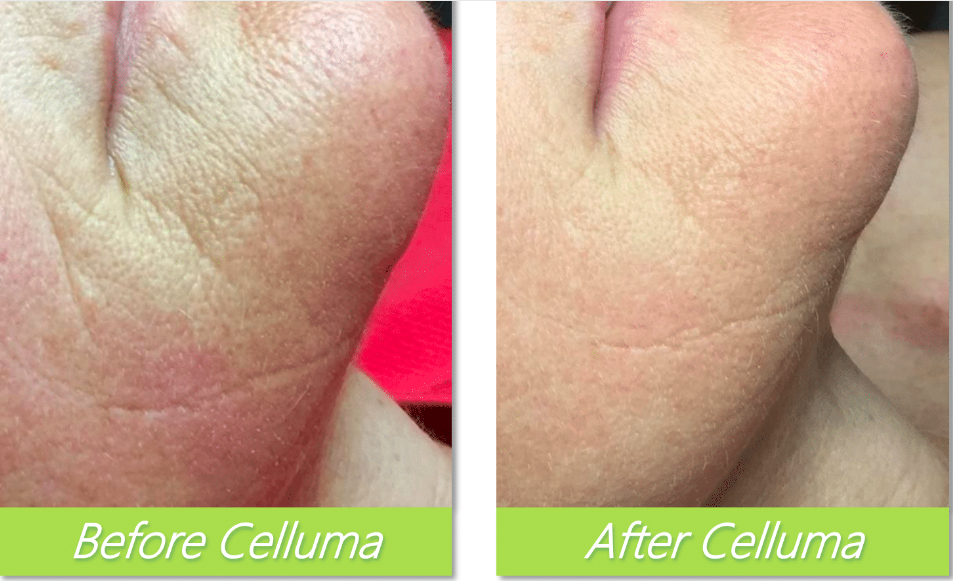 A really great result after 8 Celluma treatments.