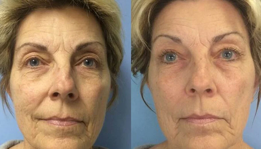 These results are with Celluma ONLY.  If they were combined with facial acupuncture, we'd see even fewer forehead wrinkles, shallower nasolabial lines, and fewer mouth lines.  The combination of the two therapies is unbeatable.