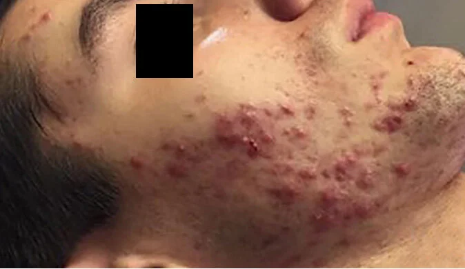 Severely inflamed acne BEFORE TREATMENT