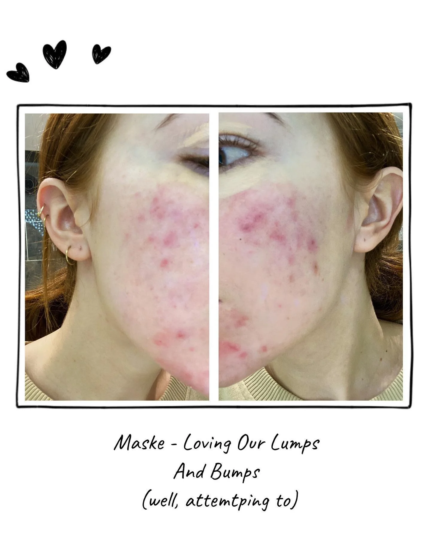 &ldquo;Despite making this potentially promising yet extremely overdue level of progress, there remains so much we aren&rsquo;t exposed to due to it not fitting in to what is considered societies &lsquo;pretty&rsquo;. Such as Acne, and it&rsquo;s bes