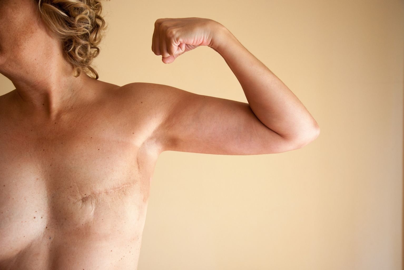 Scar Massage After Mastectomy and Radiation: What You Should Know