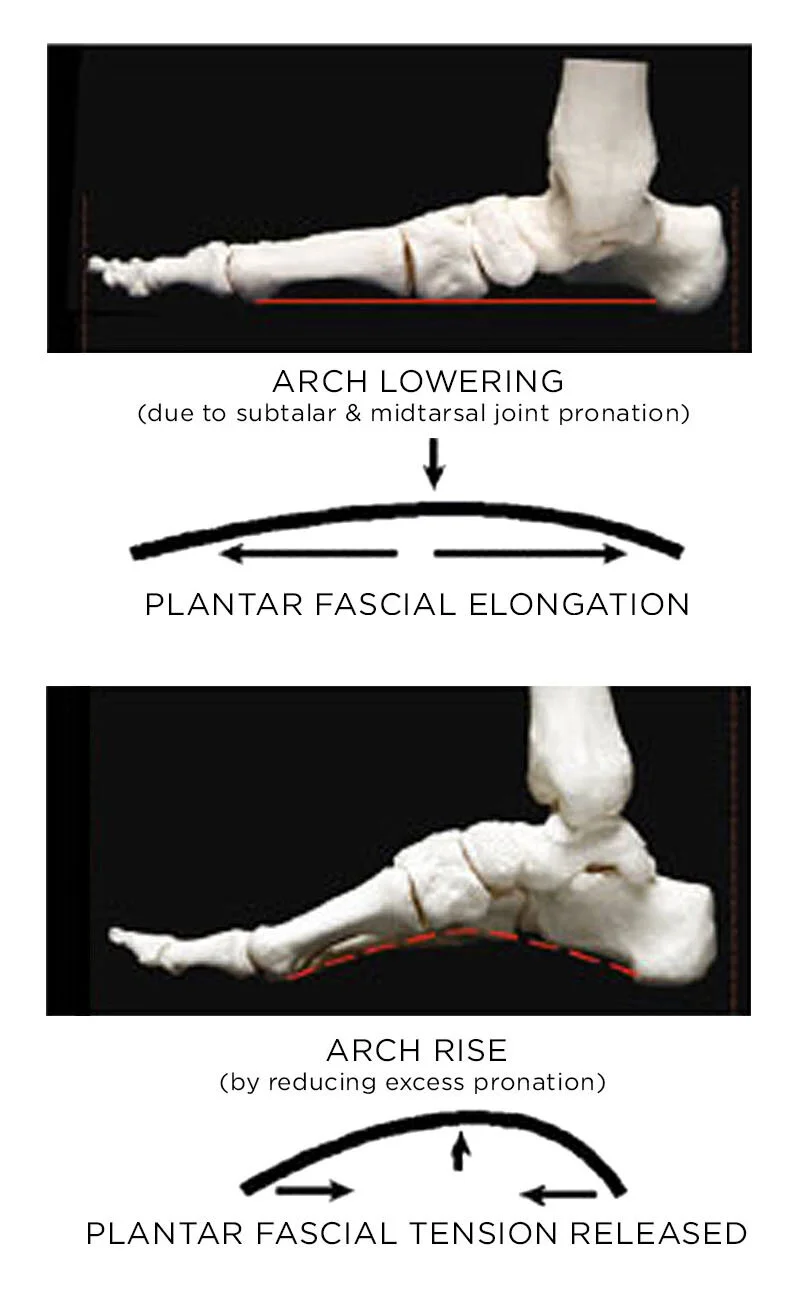 Plantar Fasciitis — Vasyli Medical