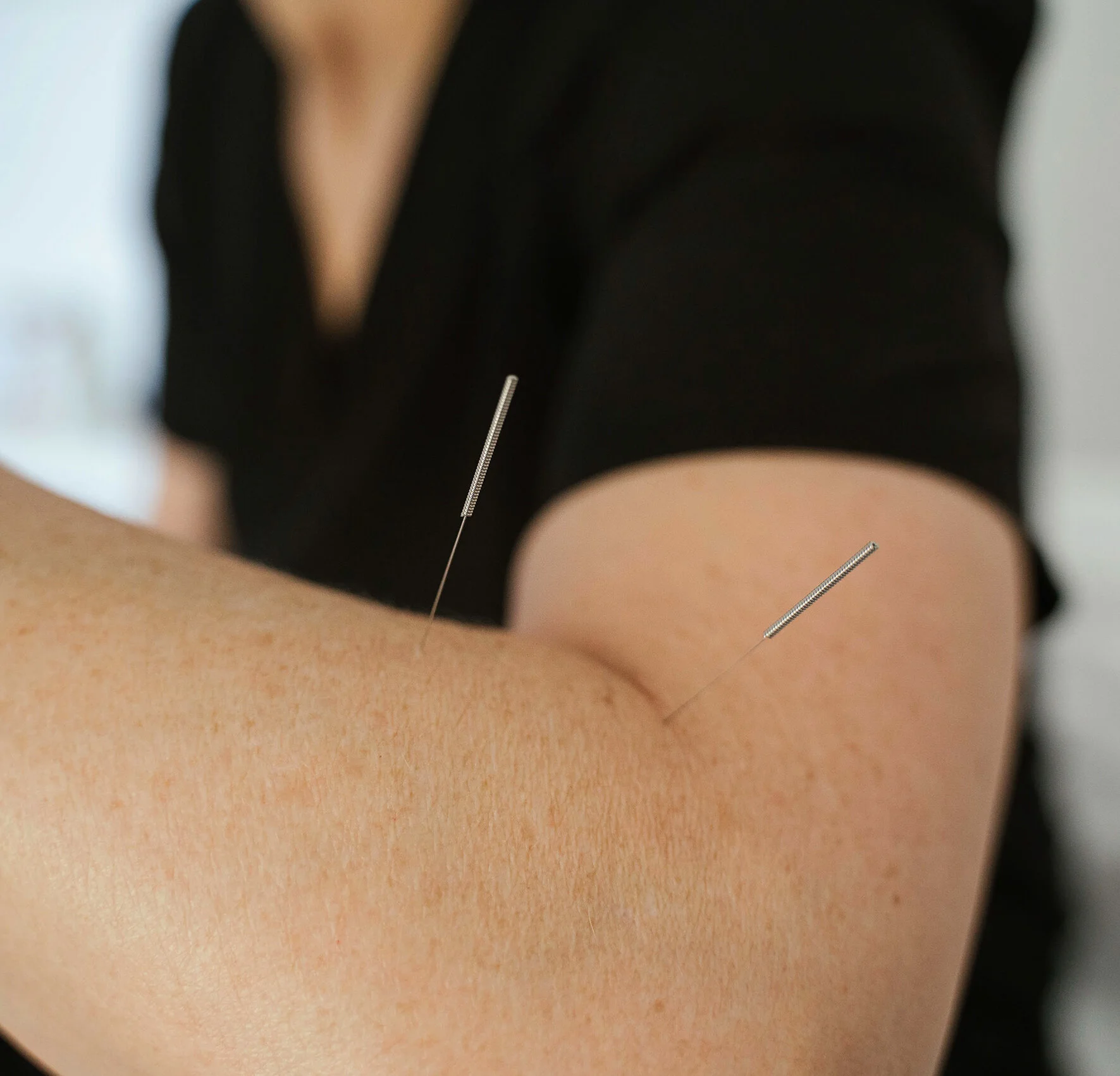 What is Acupuncture and can it help me?