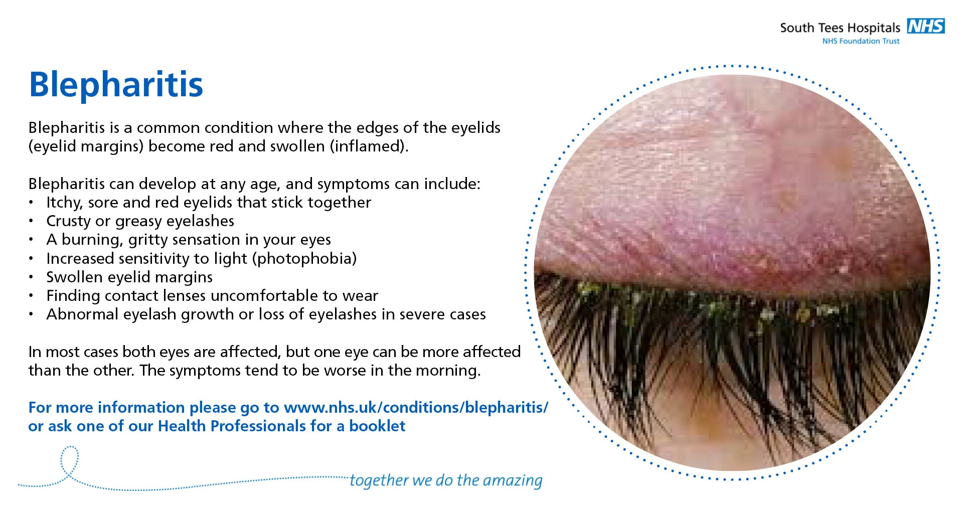 THMG-ST-SomeCommonEyeConditions-5-Blepharitis.jpg