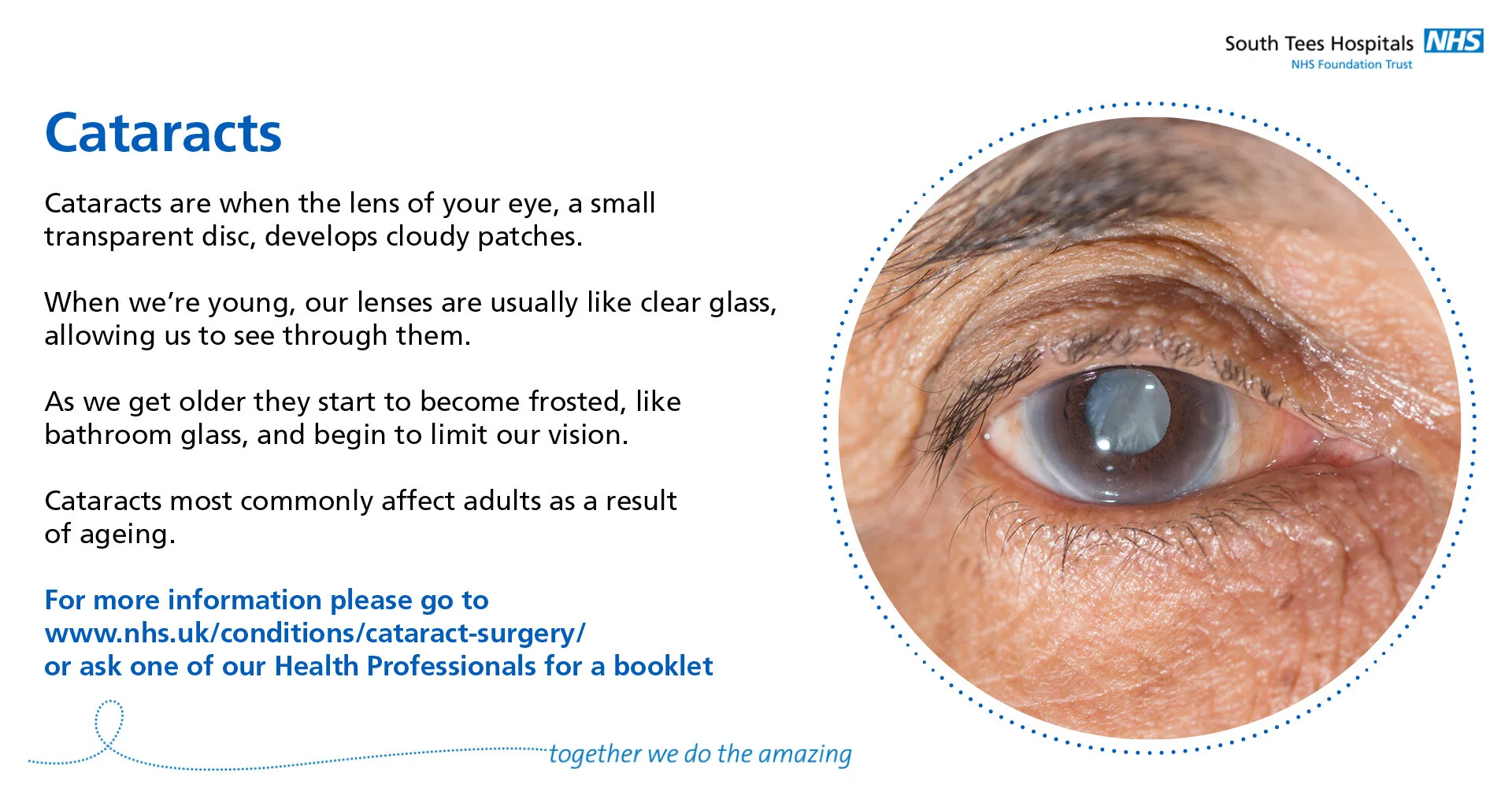 THMG-ST-SomeCommonEyeConditions-4-Cataracts.jpg