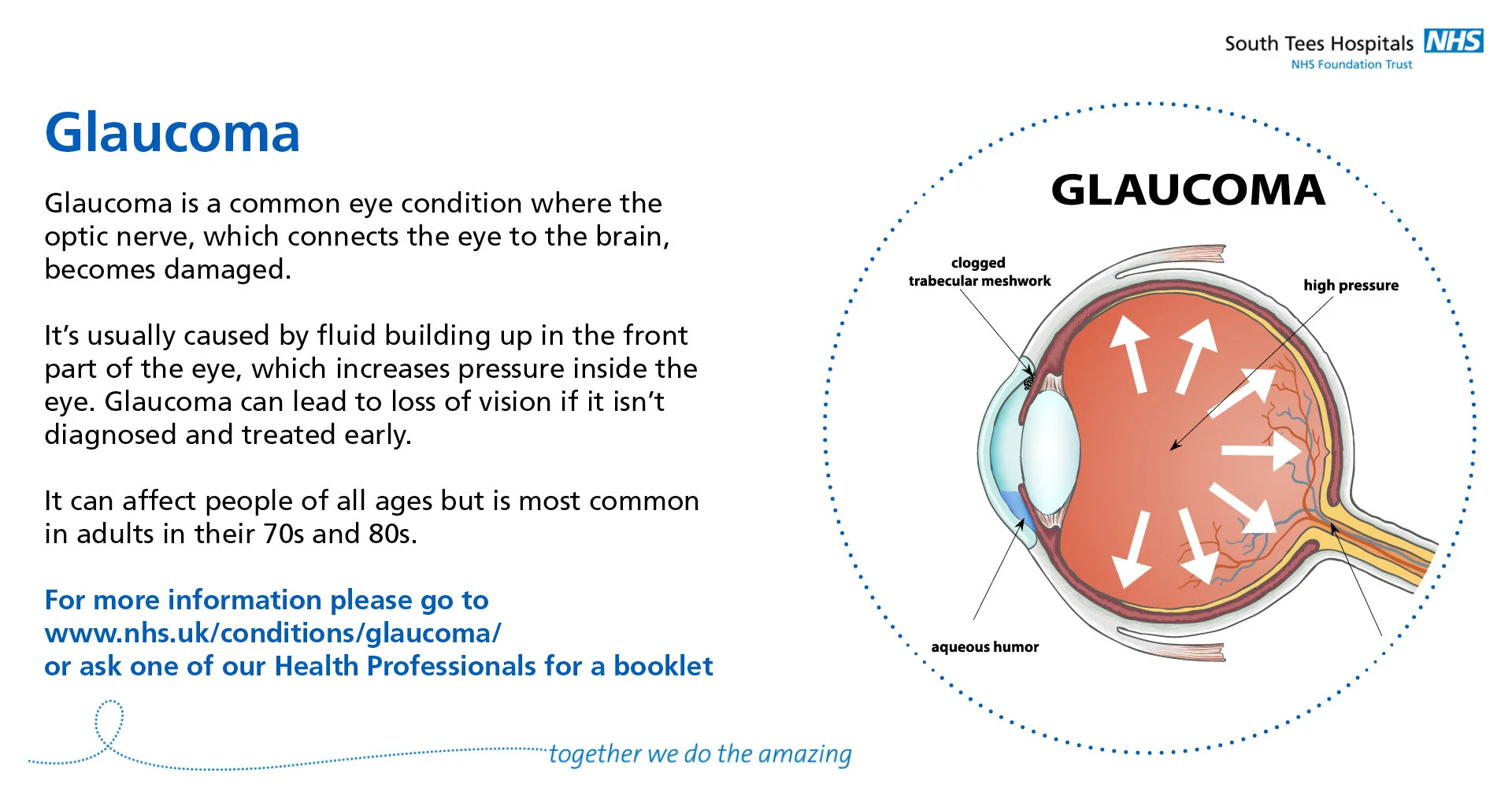 THMG-ST-SomeCommonEyeConditions-2-Glaucoma.jpg