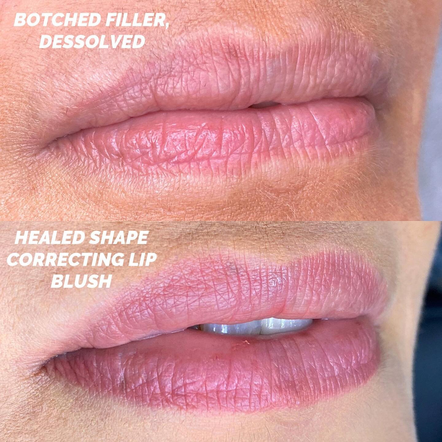 Lip Blush 💋 is a cosmetic tattoo treatment that can be fun, but also so necessary for others 🥹 This client went through a series of incorrect product being injected into her lips. After finally having them dissolved of her mystery botched filler&he