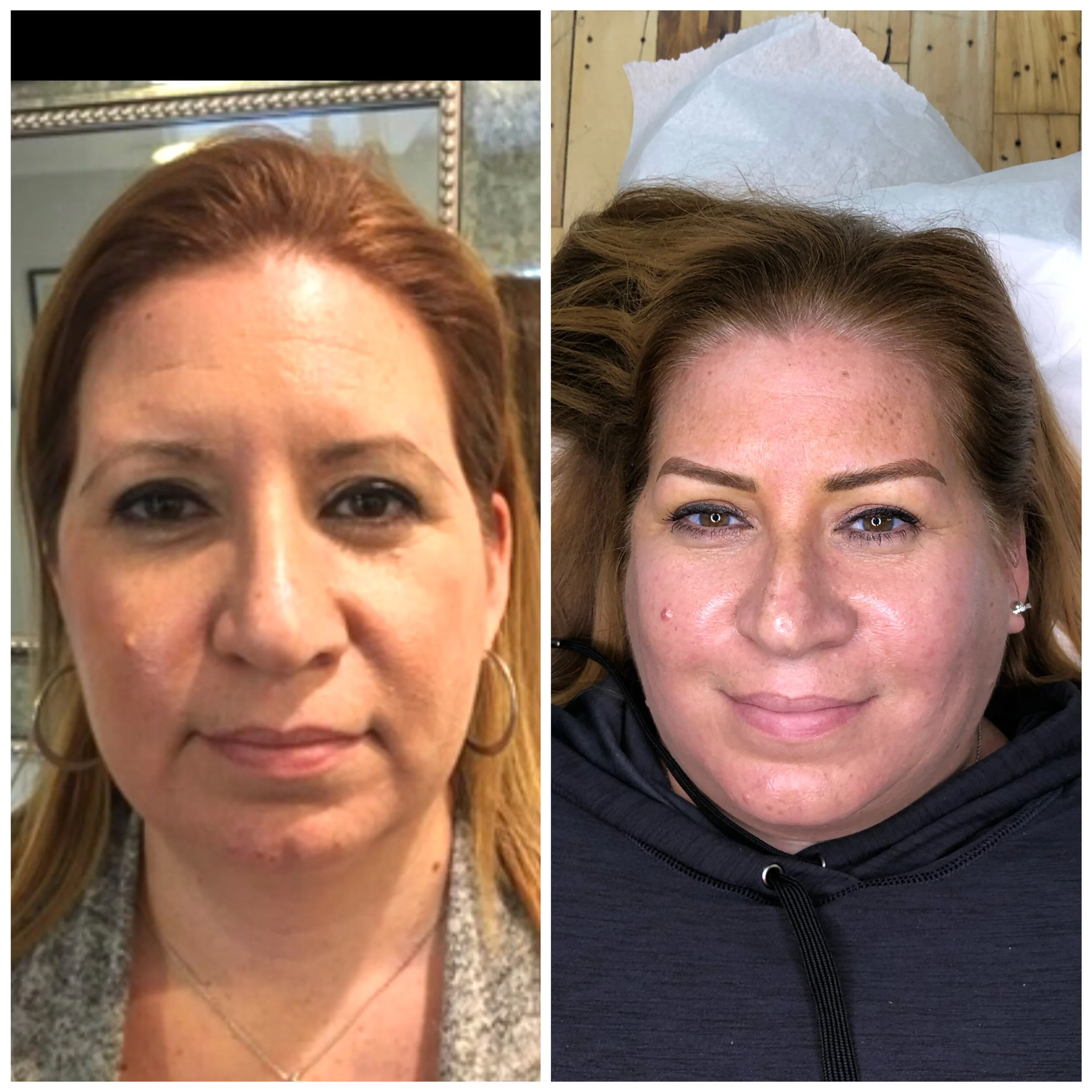 Side-by-side comparison of a woman before and after cosmetic treatment, showing improved skin texture and appearance.