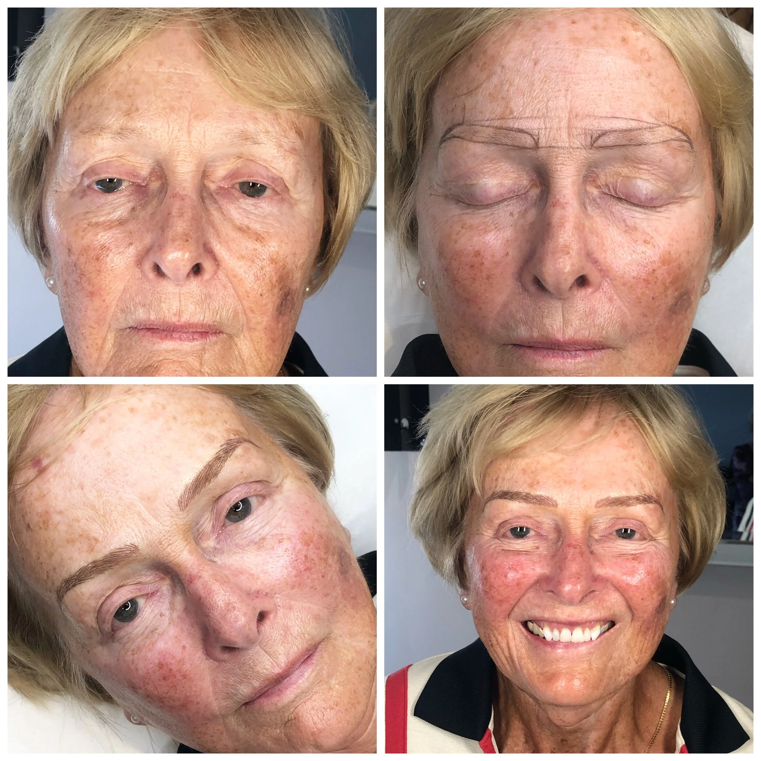A collage of four photos showing the progression of a woman's facial appearance, from having uneven skin tone and age spots to a more even complexion with a bright smile, likely after a skincare treatment or makeover.