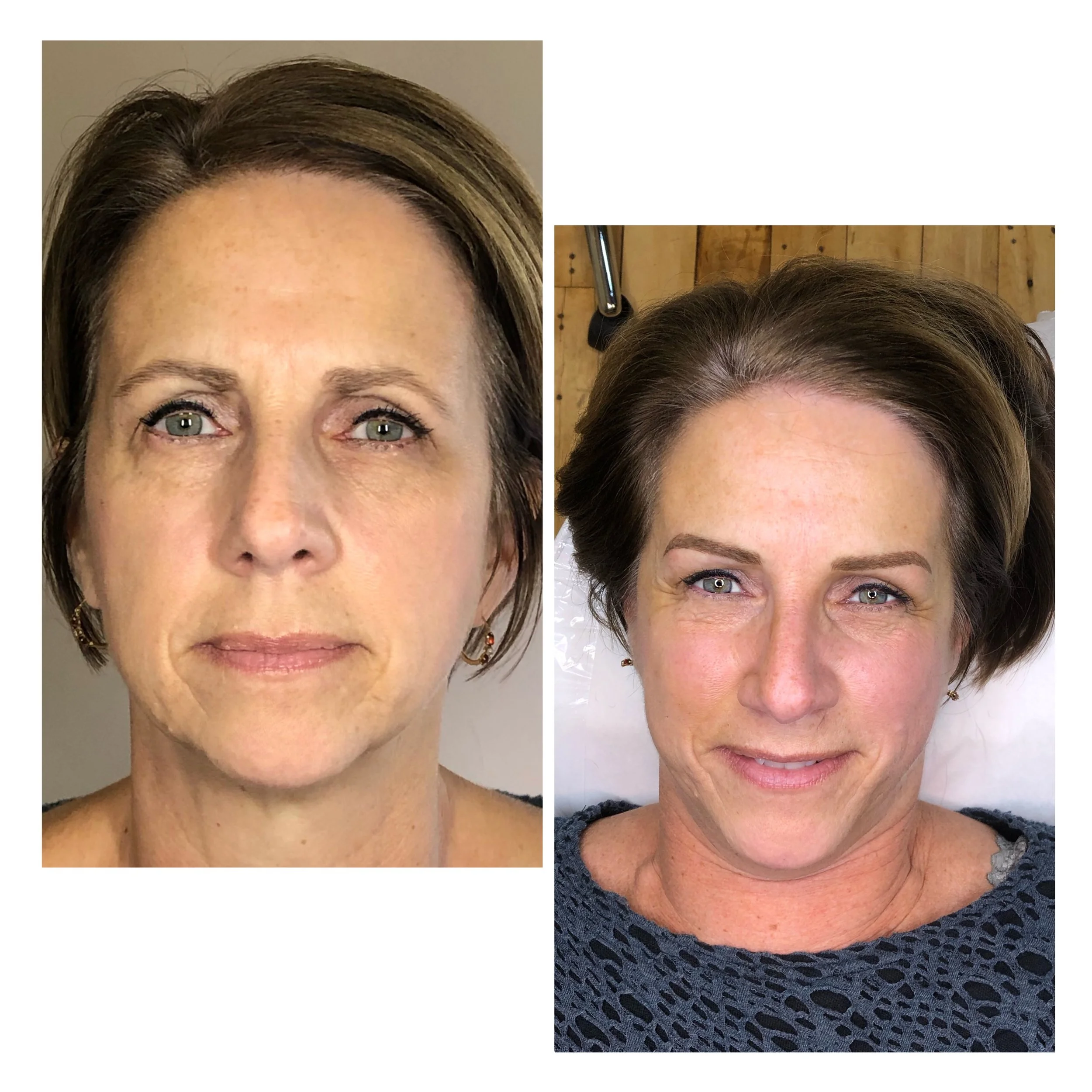 Side-by-side comparison of a woman before and after cosmetic treatment, showing improved skin texture, reduced wrinkles, and a more youthful appearance.
