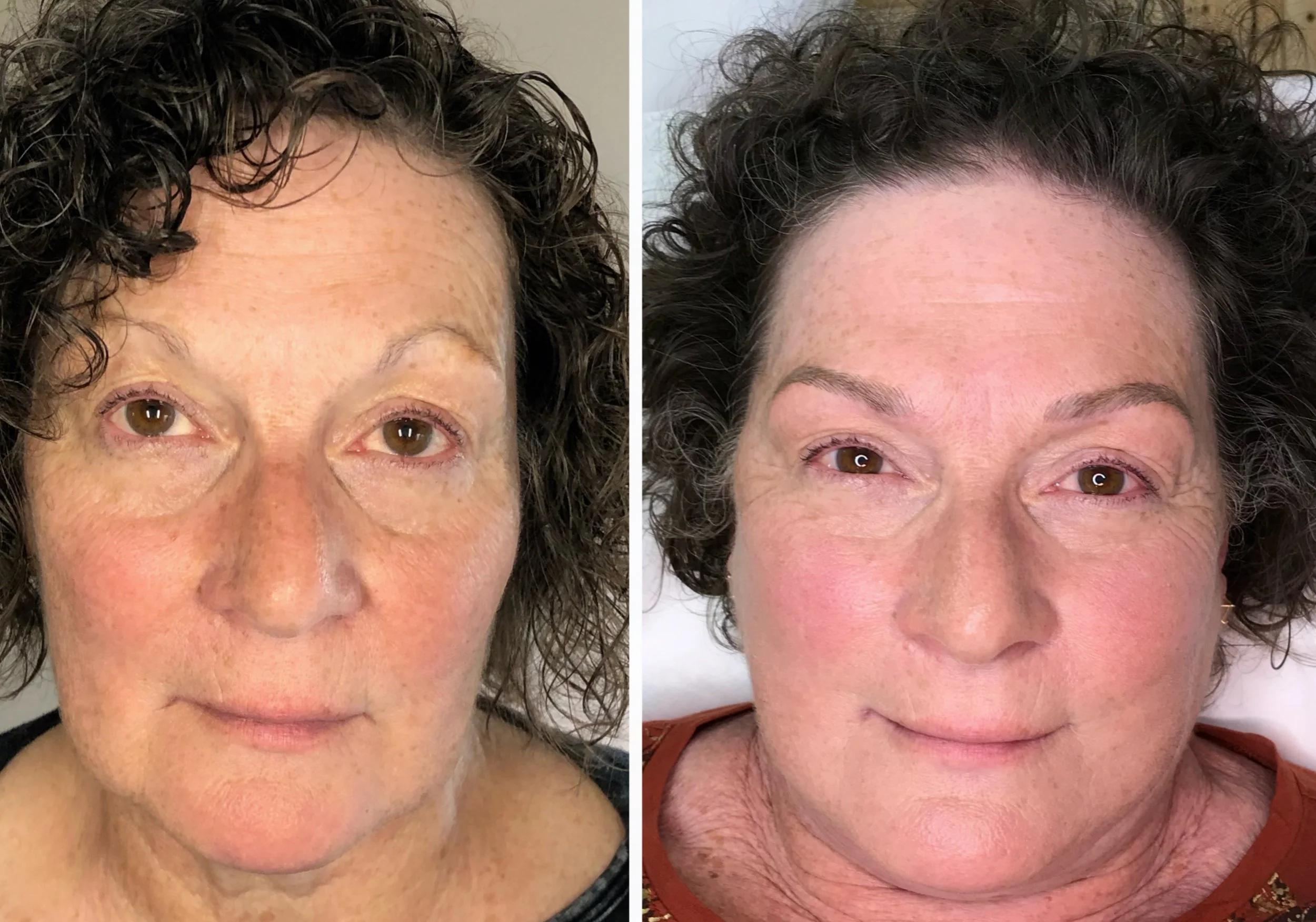 Side-by-side comparison of a woman's face before and after skincare or cosmetic treatment, showing reduced wrinkles and improved skin texture.