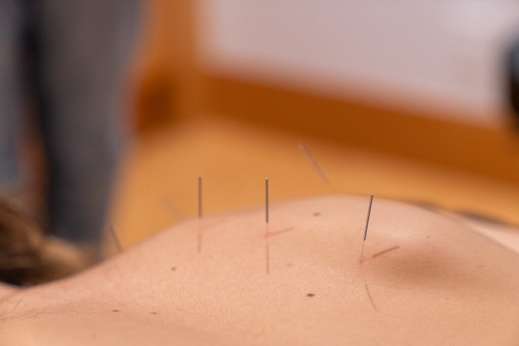 ✨ WELLNESS WEDNESDAY ✨⁠
⁠
Acupoints - What and where are they?⁠
⁠
During an Acupuncture session, our Traditional Chinese Medicine Therapists insert thin steel needles into the skin at multiple &ldquo;acupoints.&rdquo; The needles rebalance the body&r