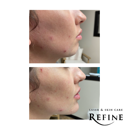 Jawline & Chin Reshaping