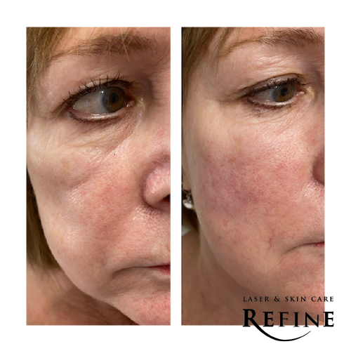 Cheek Area with Filler