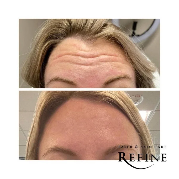 Botox Injections