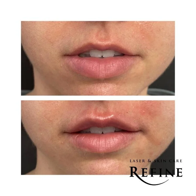 Lip Filler