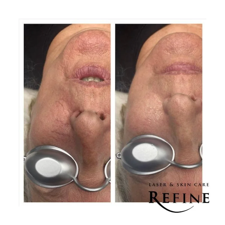 Vein Removal BBL Hero