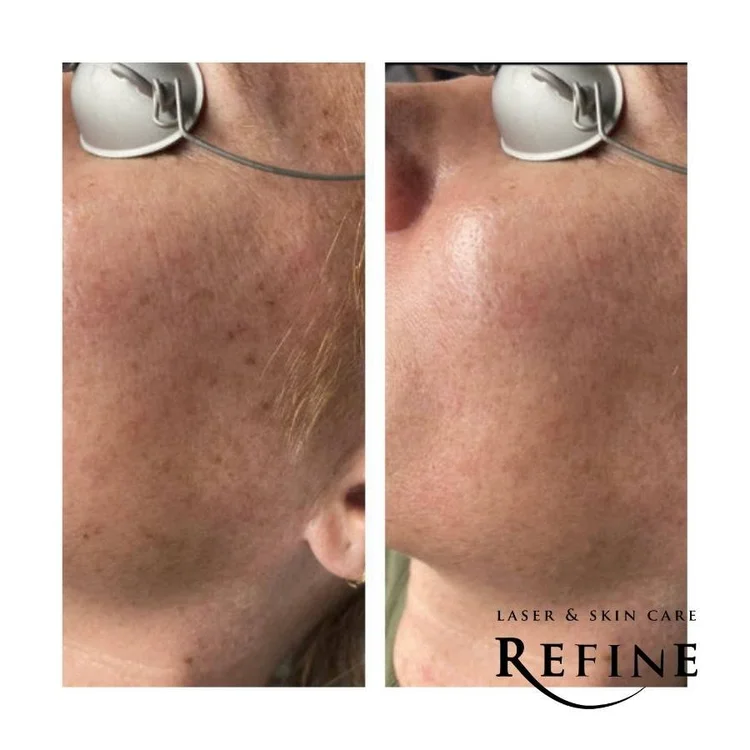 BBL Hero Sun Damage